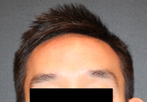 Hairline Lowering/Forehead Reduction Case 3293 Before Photo Hairline Lowering/Forehead Reduction