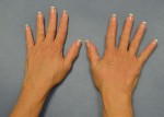 Hand Rejuvenation