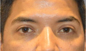 Blepharoplasty Case 3344 After Photo Blepharoplasty