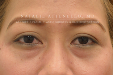 Fillers and Injectables