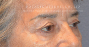 Blepharoplasty Case 3415 Before Photo Blepharoplasty