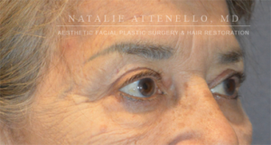 Blepharoplasty Case 3415 After Photo Blepharoplasty