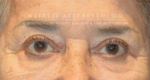 Blepharoplasty Case 3415 After Photo Blepharoplasty