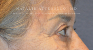 Blepharoplasty Case 3415 After Photo Blepharoplasty