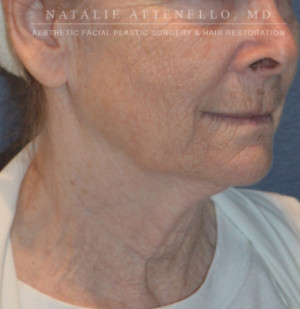 Facelift Case 3441 Before Photo Facelift