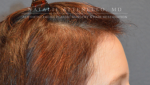 Hair Restoration