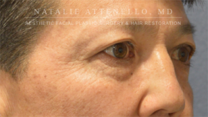 Blepharoplasty Case 3504 Before Photo Blepharoplasty