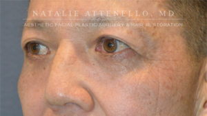 Blepharoplasty Case 3504 After Photo Blepharoplasty