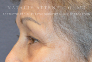 Blepharoplasty Case 3527 Before Photo Blepharoplasty