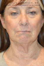 Facelift