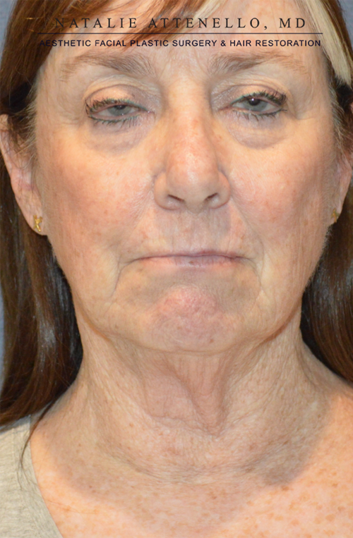 Facelift