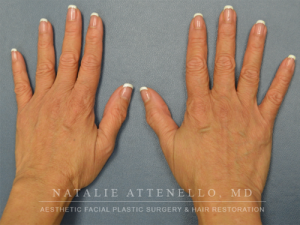 Fillers and Injectables