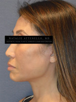 Facelift