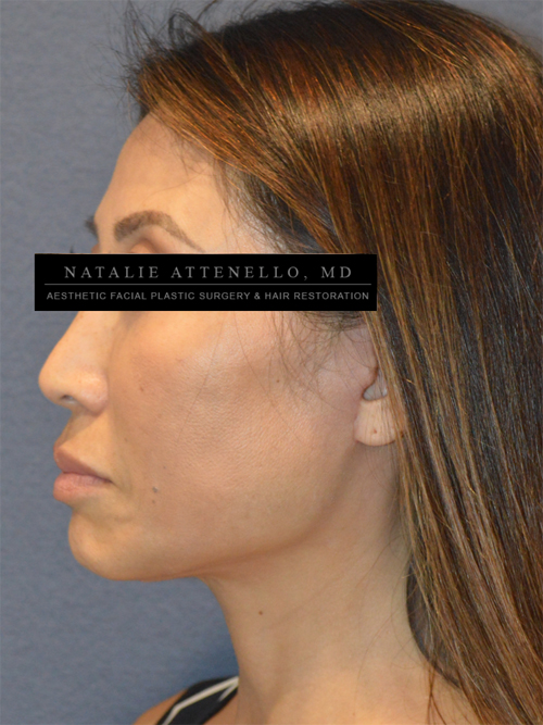 Facelift