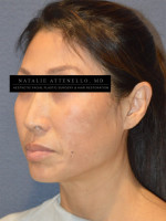 Facelift