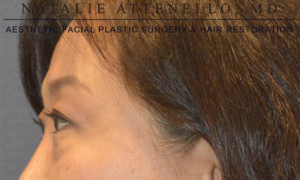 Blepharoplasty Case 3723 Before Photo Blepharoplasty