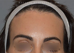 Hairline Lowering/Forehead Reduction Case 3923 After Photo Hairline Lowering/Forehead Reduction