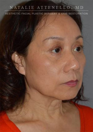 Facelift Case 3904 Before Photo Facelift