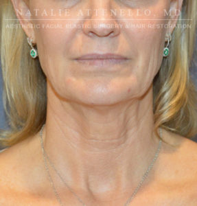 Patient #1 Before Necklift Picture