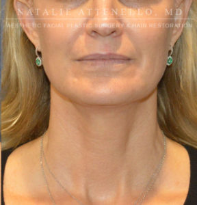 Patient #1 After Necklift Picture