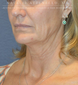 Patient #1 Before Picture