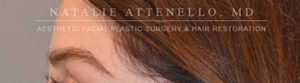Hair Restoration Case 3999 After Photo Hair Restoration
