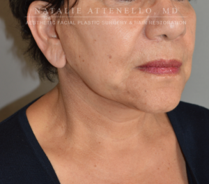 Facelift Case 4044 After Photo Facelift