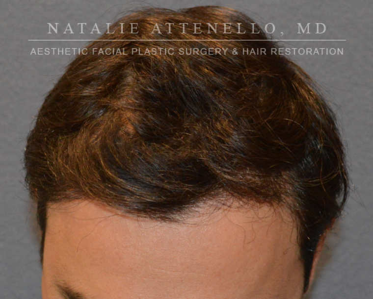 Hair Restoration
