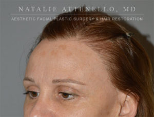 Hair Restoration Case 4122 After Photo Hair Restoration