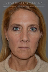 Patient #2 Before Picture