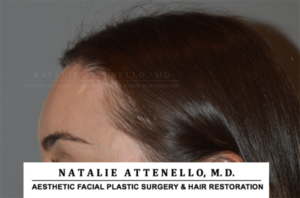 Hairline Lowering/Forehead Reduction Case 4148 After Photo Hairline Lowering/Forehead Reduction