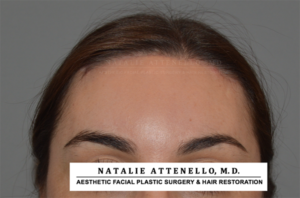 Hairline Lowering/Forehead Reduction Case 4148 After Photo Hairline Lowering/Forehead Reduction