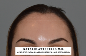 Hairline Lowering/Forehead Reduction Case 4148 Before Photo Hairline Lowering/Forehead Reduction
