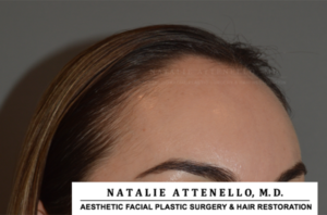 Hairline Lowering/Forehead Reduction Case 4148 Before Photo Hairline Lowering/Forehead Reduction
