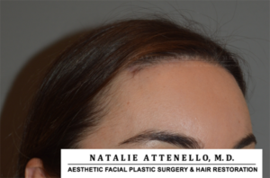 Hairline Lowering/Forehead Reduction Case 4148 After Photo Hairline Lowering/Forehead Reduction