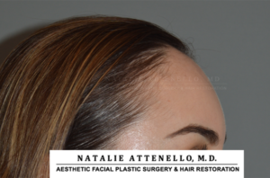 Hairline Lowering/Forehead Reduction Case 4148 Before Photo Hairline Lowering/Forehead Reduction