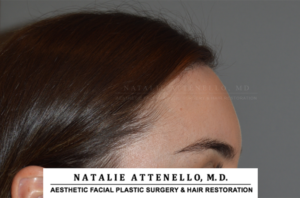 Hairline Lowering/Forehead Reduction Case 4148 After Photo Hairline Lowering/Forehead Reduction