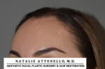 Hairline Lowering/Forehead Reduction