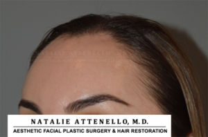 Hairline Lowering/Forehead Reduction Case 4148 Before Photo Hairline Lowering/Forehead Reduction