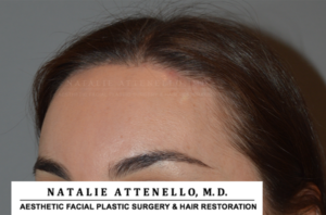 Hairline Lowering/Forehead Reduction Case 4148 After Photo Hairline Lowering/Forehead Reduction
