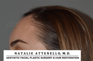 Hairline Lowering/Forehead Reduction Case 4148 Before Photo Hairline Lowering/Forehead Reduction