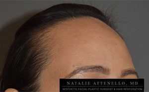 Hairline Lowering/Forehead Reduction Case 4189 Before Photo Hairline Lowering/Forehead Reduction