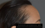 Hairline Lowering/Forehead Reduction