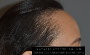 Hairline Lowering/Forehead Reduction Case 4189 Before Photo Hairline Lowering/Forehead Reduction