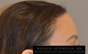 Hairline Lowering/Forehead Reduction Case 4189 After Photo Hairline Lowering/Forehead Reduction