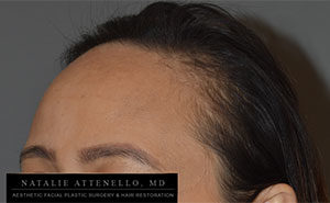 Hairline Lowering/Forehead Reduction Case 4189 Before Photo Hairline Lowering/Forehead Reduction