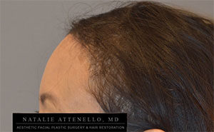 Hairline Lowering/Forehead Reduction Case 4189 After Photo Hairline Lowering/Forehead Reduction
