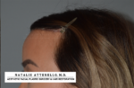 Hairline Lowering/Forehead Reduction