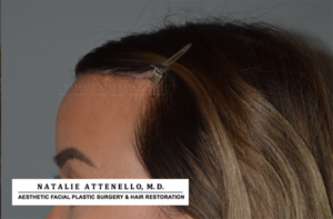 Hairline Lowering/Forehead Reduction Case 4178 After Photo Hairline Lowering/Forehead Reduction