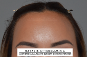 Hairline Lowering/Forehead Reduction Case 4178 Before Photo Hairline Lowering/Forehead Reduction